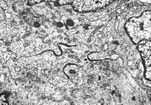  F,11y. | ependymoma